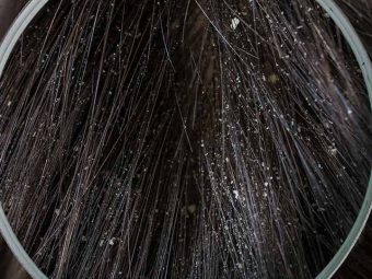 Different Types Of Dandruff And How To Stop Them