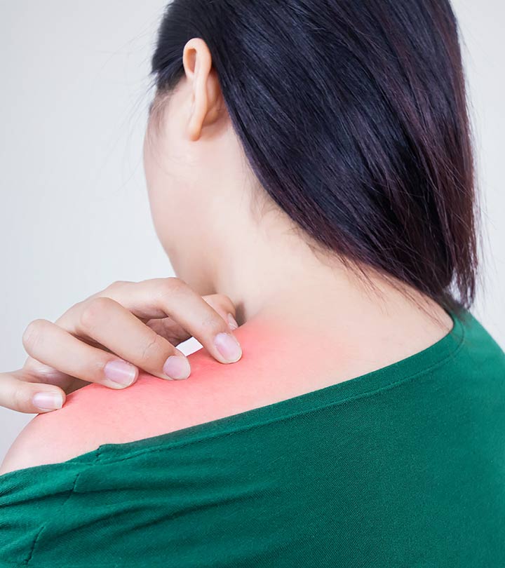 28 Home Remedies For Prickly Heat That Provide Quick Relief