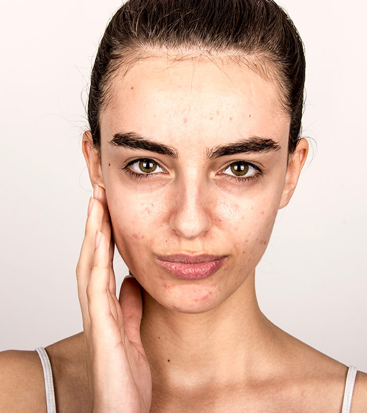 Acne Face Map: What Your Breakouts Are Trying To Tell You