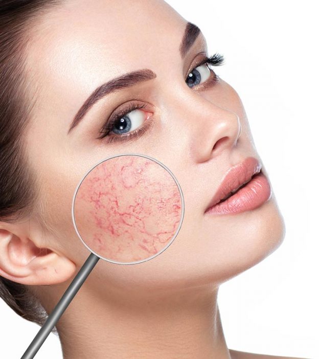6 Quick Ways To Get Rid Of Broken Capillaries On The Face