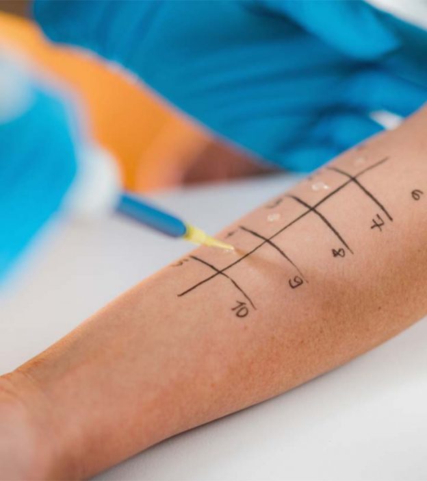 Everything You Need To Know About Skin Allergy Tests