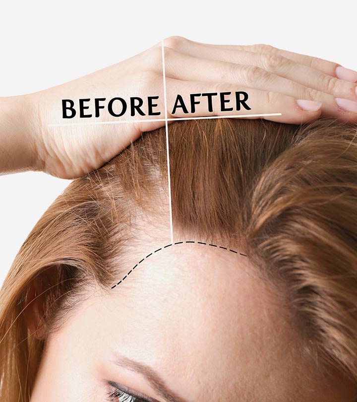 Hair Transplant Growth Timeline: What Can You Expect?