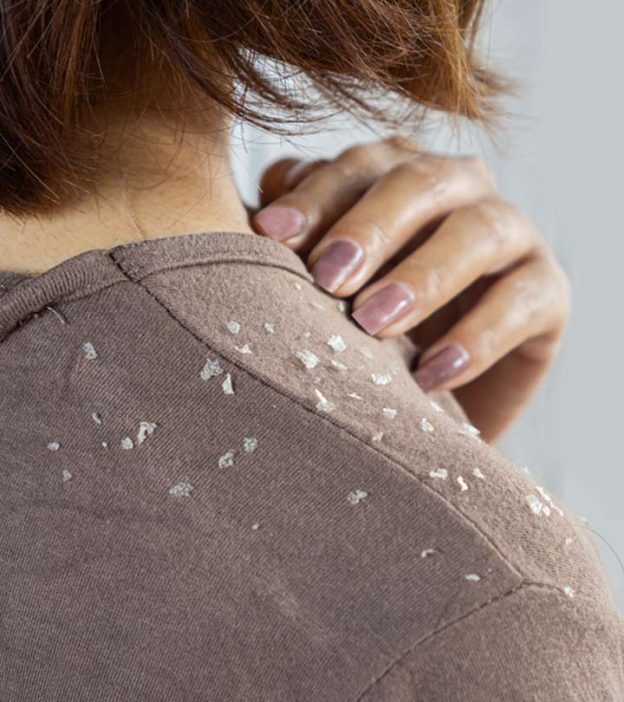 How To Get Rid Of Dandruff In Winter Naturally