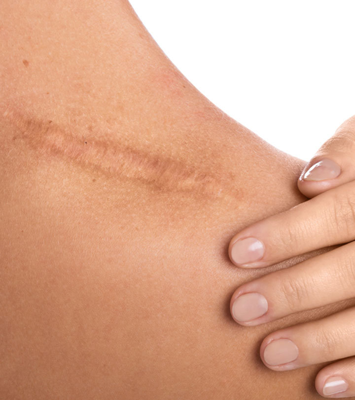 Scar Tissue: Symptoms, Treatment, And How To Manage Pain