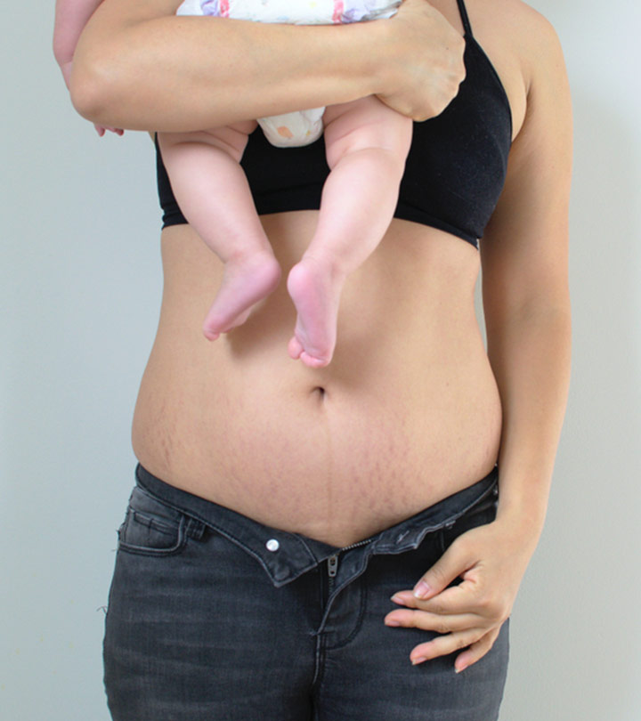 Stretch Marks: Types, Causes, & How To Manage And Reduce Them