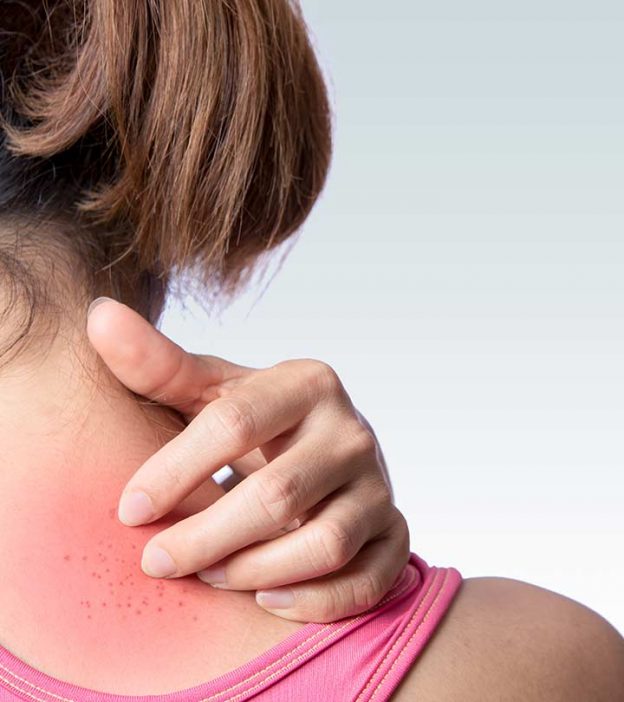 What Causes Heat Rash In Adults? How To Treat It?